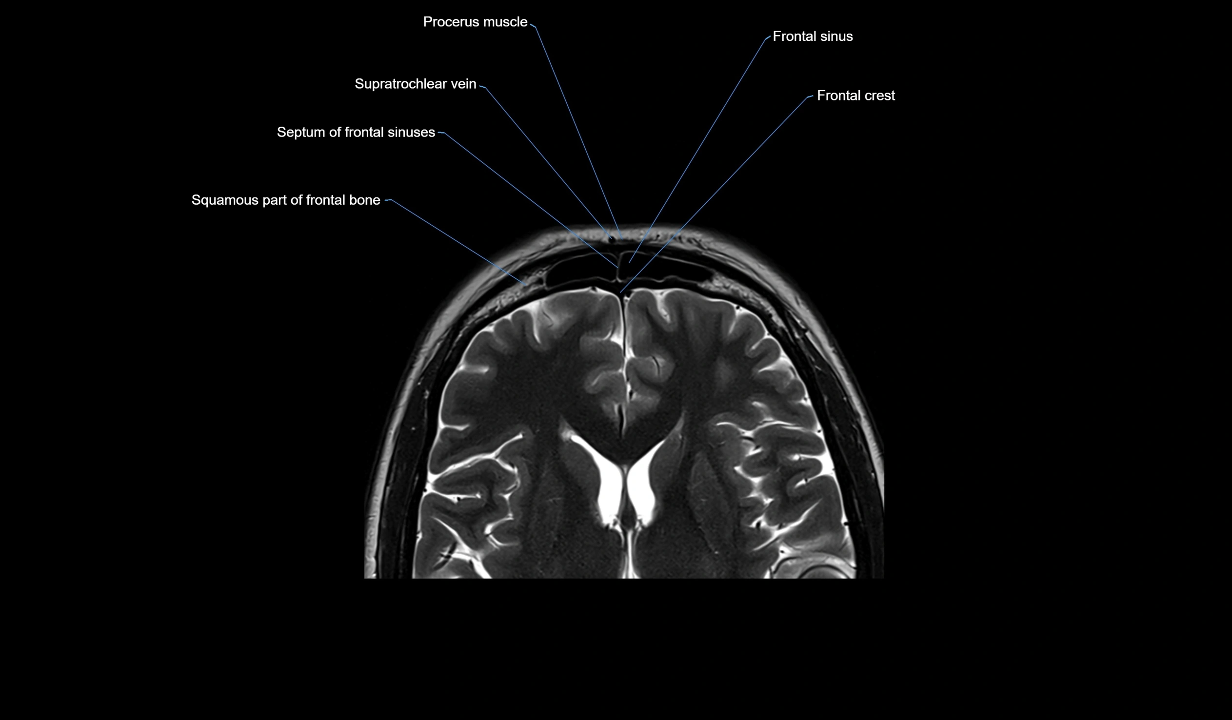 MRI face & paranasal sinuses(PNS) labelled  coronal  cross sectional anatomy 3T radiology  image-img-00001-00031.webp